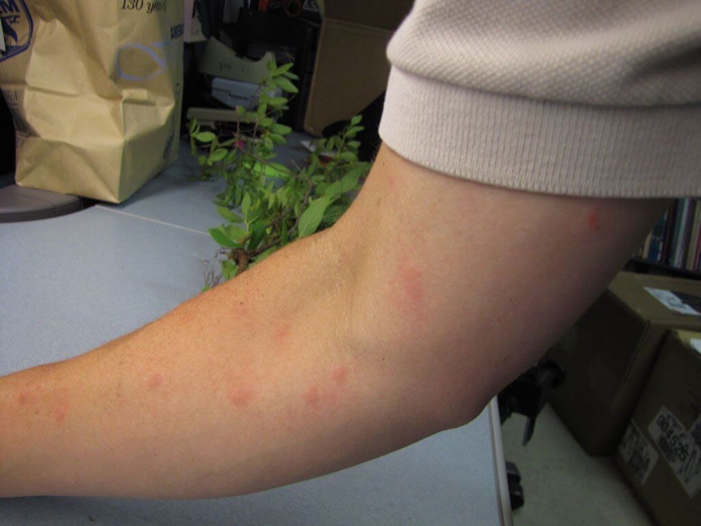 Bed Bug Bites